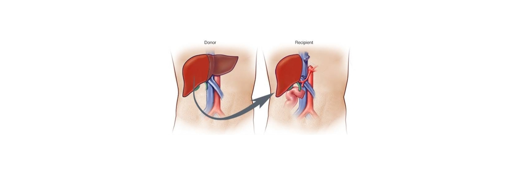 Liver Transplant