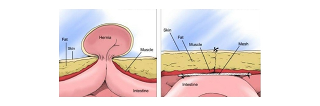 Laparoscopic Hernia Repair