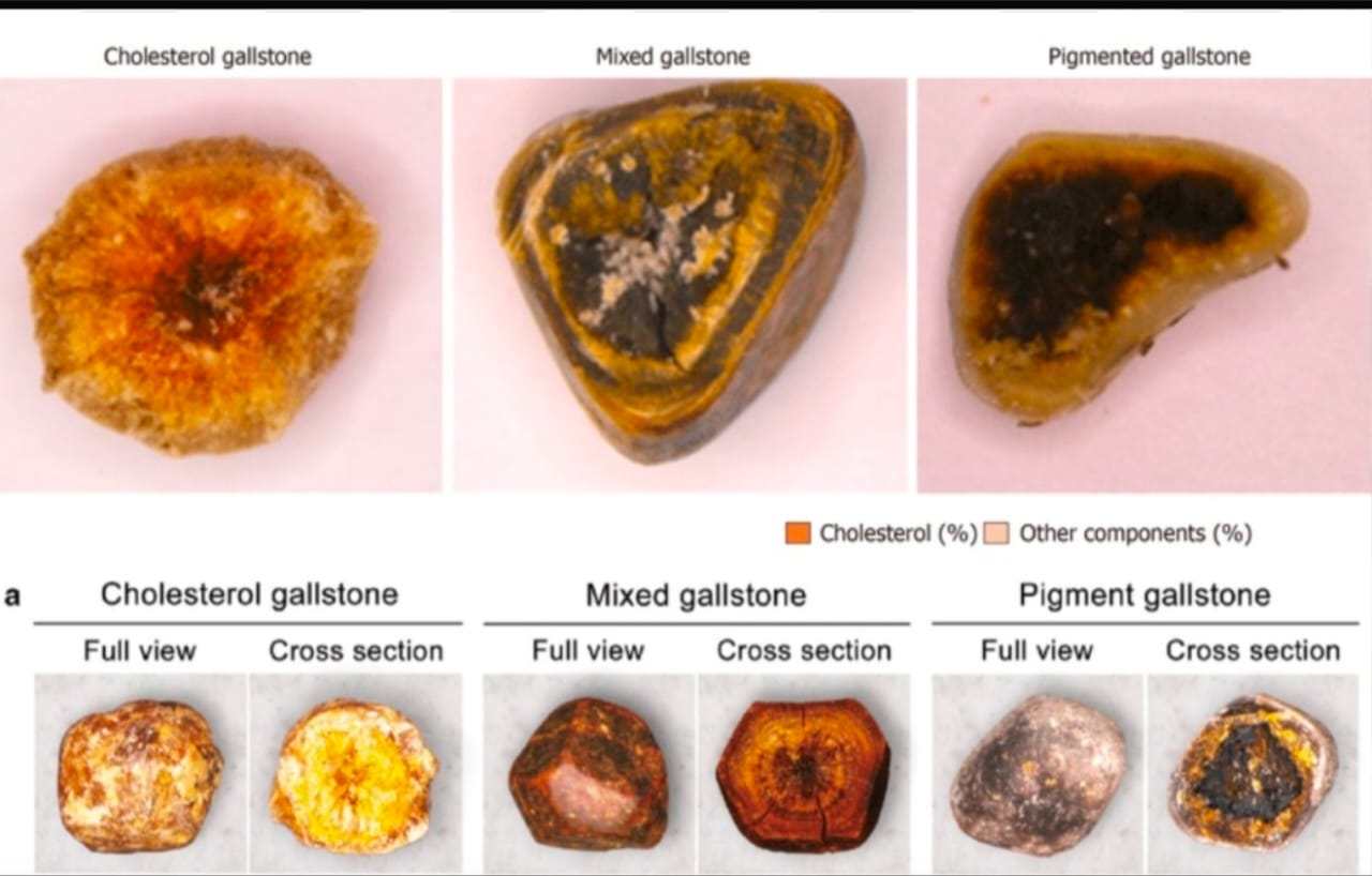 Gallstones