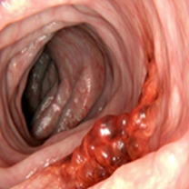Onco (Cancer)