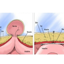 Laparoscopic Hernia Repair