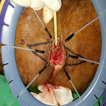 Proctology (Fissure, Fistula & Hemorrhoids)