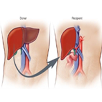 Liver Transplant